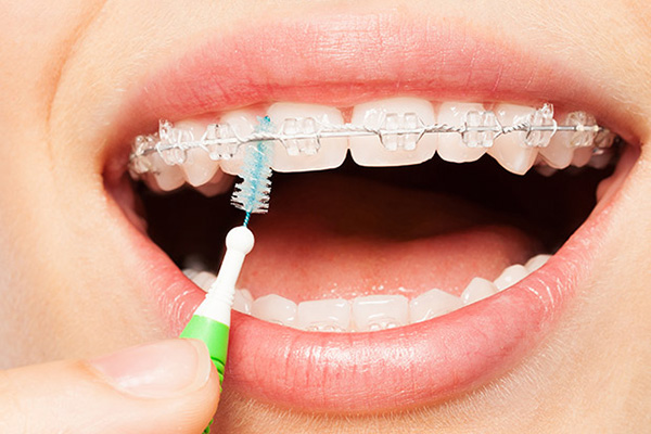Consider Clear Braces For Straighter Teeth
