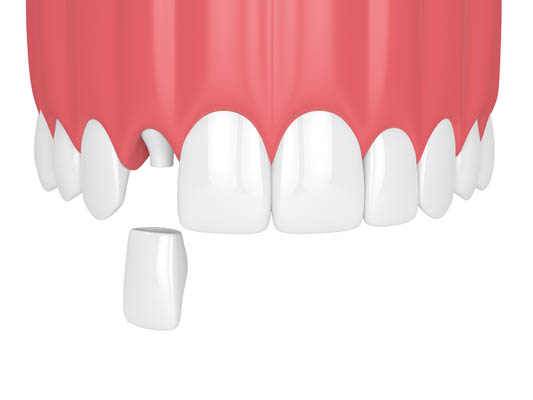 Dental Crown For A Tooth Restoration