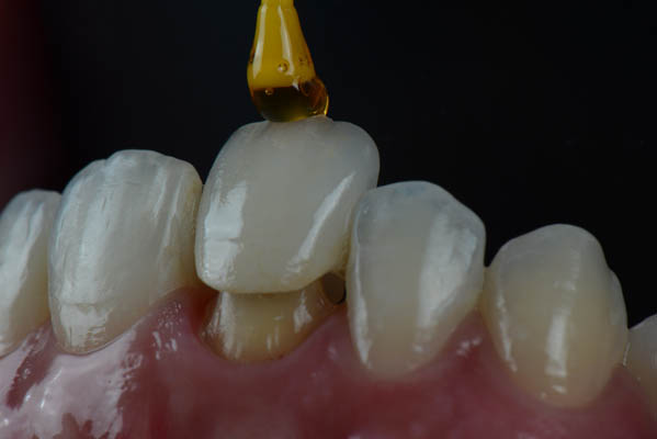How A Dental Crown Is Used For A Damaged Tooth