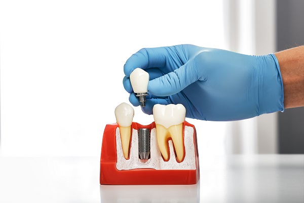 A Procedure Guide To Getting A Dental Implant