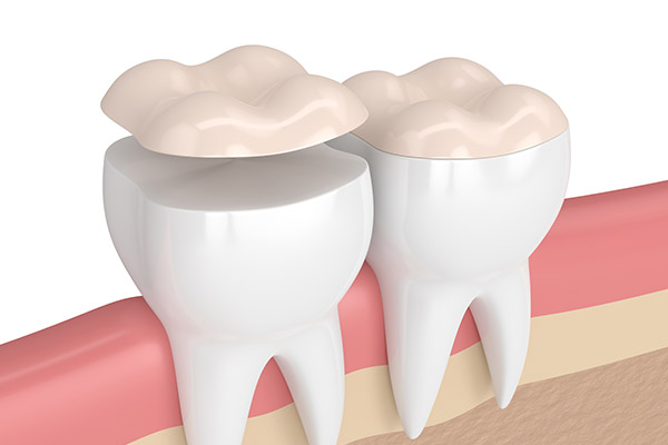 How Can A Dental Onlay Treat A Damaged Tooth?