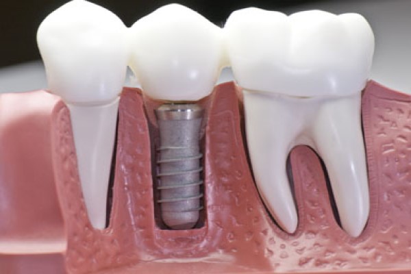 An Experienced Implant Dentist Answers FAQs